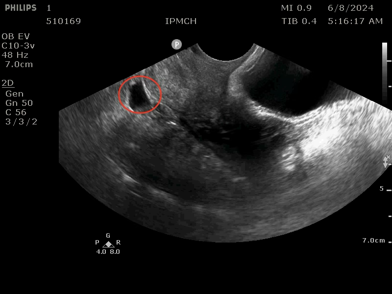 Research on Automatic Segmentation of Cesarean Scar Diverticulum Ultrasound Images Based on Deep Learning